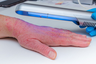  Phototherapy Devices: Where Is The Field Headed? | ZERIGO HEALTH
