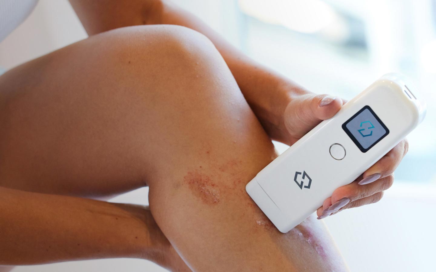 handheld UVB Smart Light Therapy device for people living with psoriasis, eczema/atopic dermatitis, & vitiligo